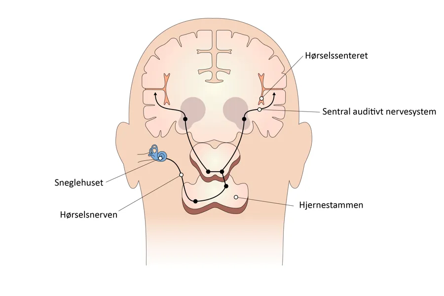 Illustrasjon av hjernen med forklaringer i tekst på hvor de forskjellige hørselsdelene sitter.